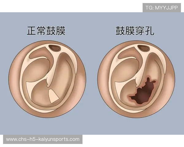 耳膜穿孔：头球不当的隐伤，耳膜穿孔能治好吗一定要手术吗